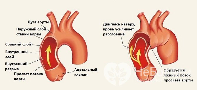 Расслоение аневризмы аорты