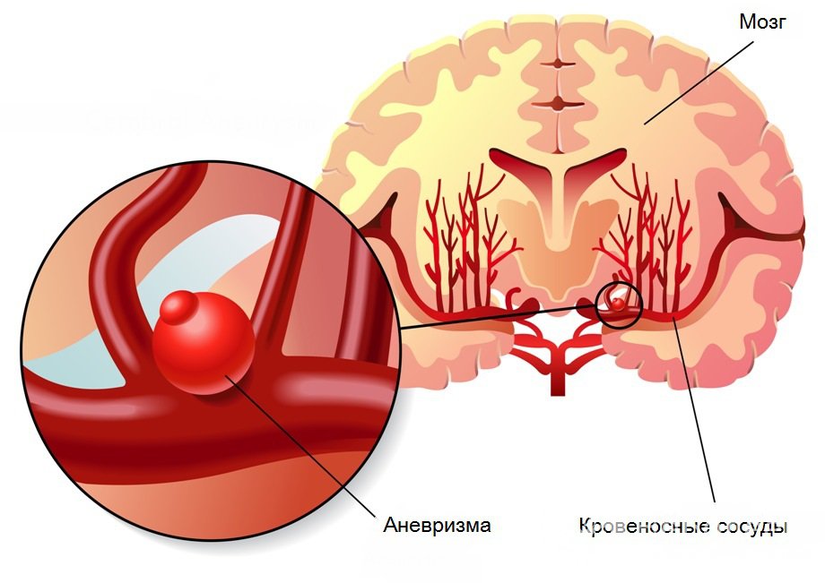 Симптомы аневризмы сосудов головного мозга 