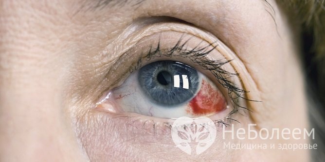 Частые кровоизлияния в глаз – симптом ангиопатии