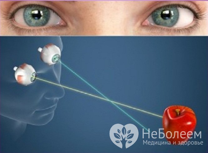 Нарушение бинокулярного зрения – основной симптом анизометропии