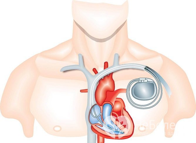Имплантация кардиостимулятора показана при неэффективности медикаментозной терапии АДПЖ