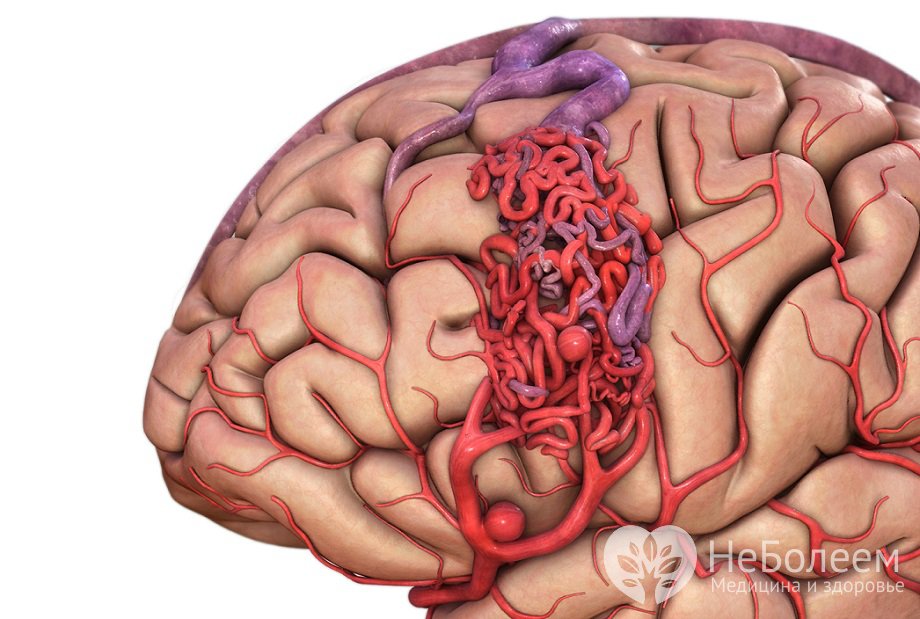 Признаки артериовенозной мальформации 