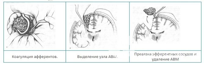 Классический способ удаления артериовенозной мальформации