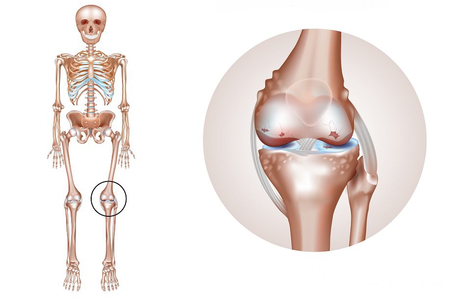 Признаки артрита коленного сустава