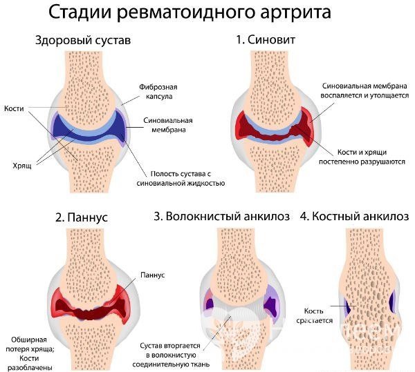Стадии ревматоидного артрита коленного сустава