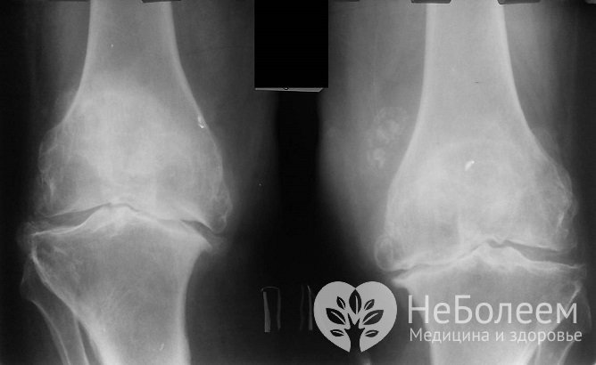 Рентгенография при артрите коленного сустава