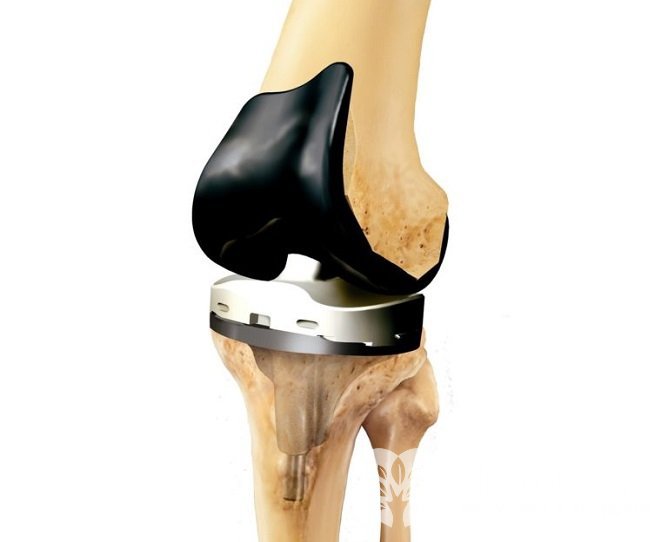 Эндопротезирование коленного сустава позволяет устранить артрит