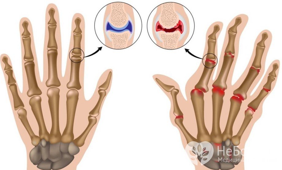 Признаки артрита пальцев рук