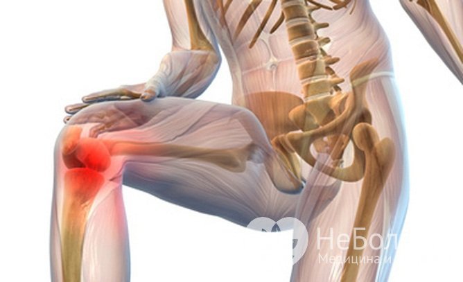 На ранних стадиях артрит проявляется умеренными болями и скованностью в суставах
