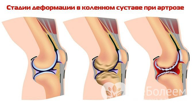 Стадии деформации коленного сустава при артрозе