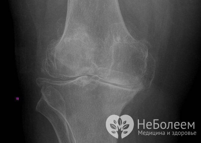 Диагноз «артроз коленного сустава» ставится на основании клинической катины в сочетании с рентгеновскими снимками