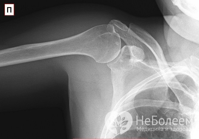 Подтвердить диагноз «артроз плечевого сустава» помогает рентгенограмма