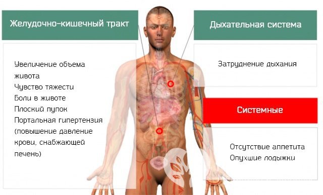 Симптомы асцита