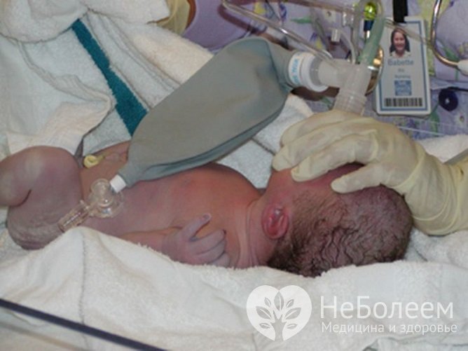 Асфиксия новорожденных проявляется нарушением дыхательной функции