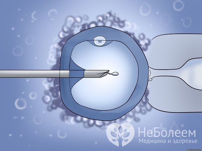 Метод искусственной инсеминации помогает решить проблему мужского бесплодия при аспермии