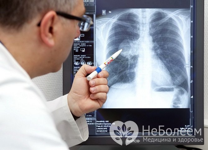 Аспирационная пневмония на рентгеновском снимке