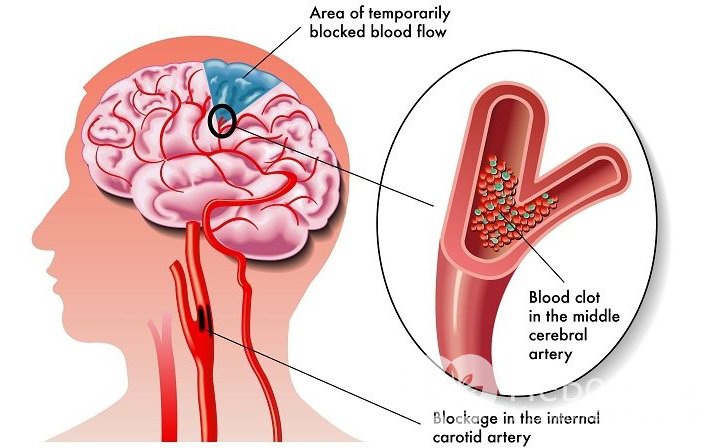 Клинические признаки атеросклероза головного мозга проявляются, когда атеросклеротическая бляшка перекрывает кровоток