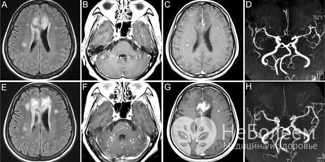Один из методов диагностики атеросклероза сосудов головного мозга – МРТ головного мозга