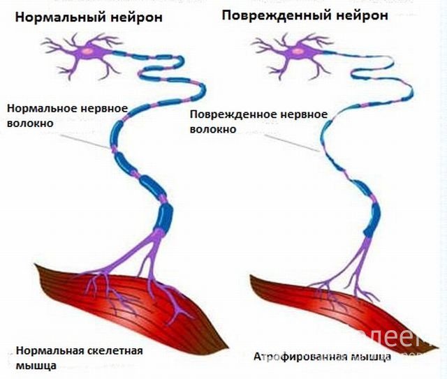 Причиной атонии может служить нарушение влияние нервной системы на мышечные волокна