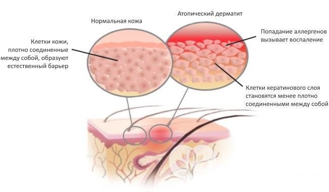 Причина атопического дерматита – наследственная предрасположенность к аллергиям
