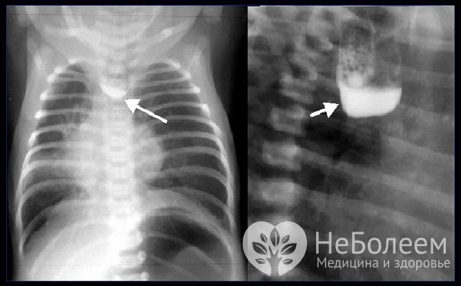 Рентгеновский снимок атрезии пищевода у ребенка