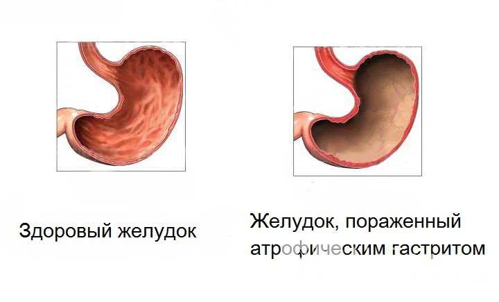 Атрофический Гастрит Симптомы И Лечение Диета