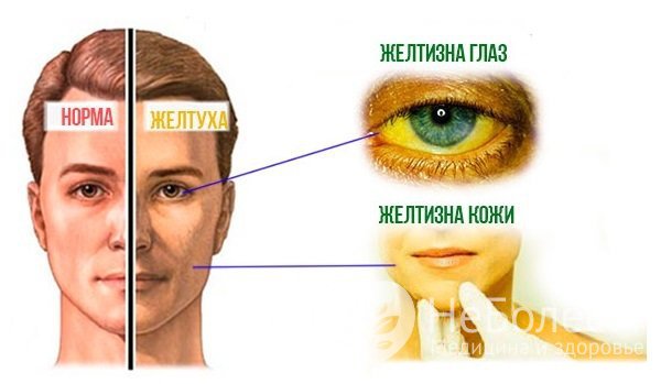 Основные симптомы аутоиммунного гепатита – пожелтение кожи и белков глаз