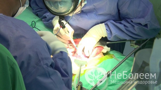 В тяжелых случаях аутоиммунного гепатита необходима операция по трансплантации печени