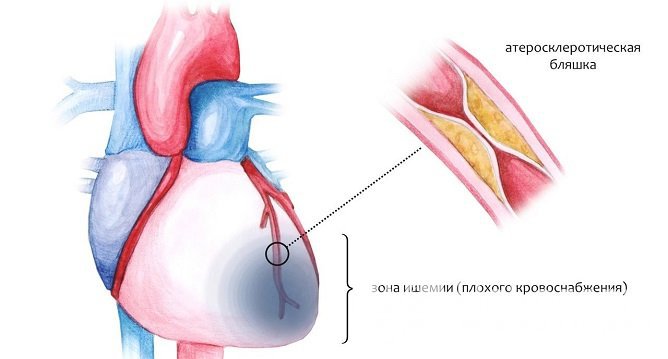 Блокада сердца может возникать на фоне ИБС и прочих органических заболеваний, поражающих сердечную мышцу