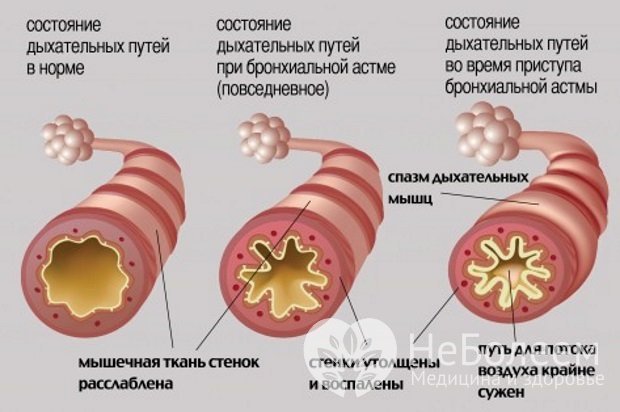 Состояние дыхательных путей при бронхиальной астме