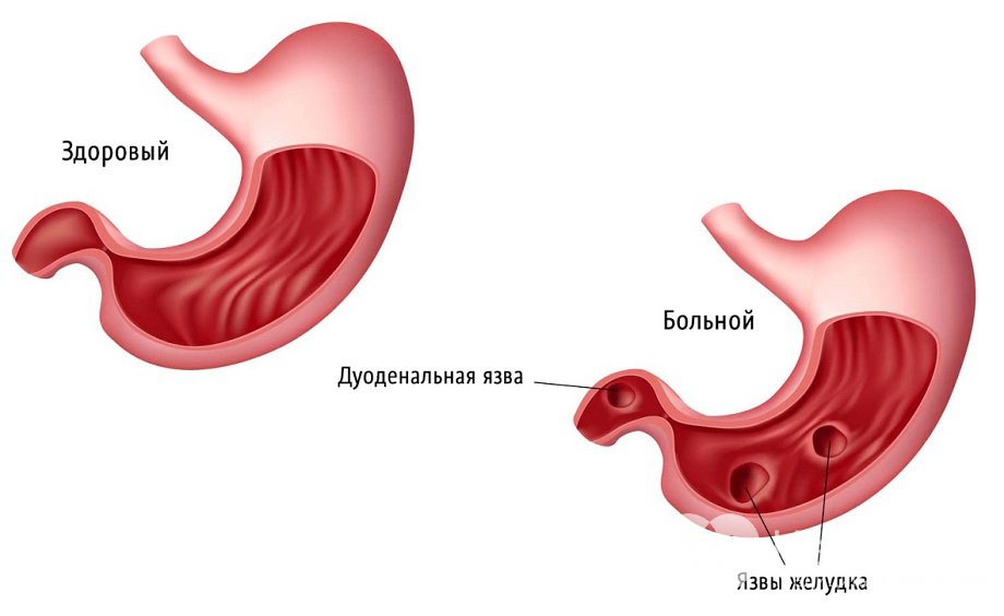 Очаговый Бульбит Симптомы И Лечение Диета