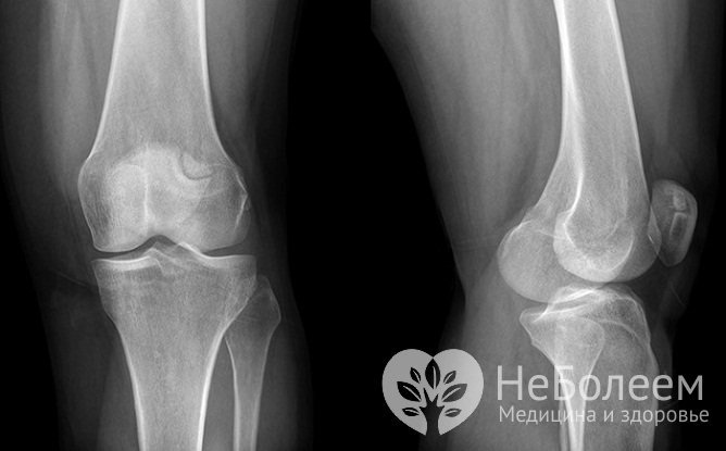 Подтвердить диагноз бурсита позволяет рентгенографическое исследование коленного сустава