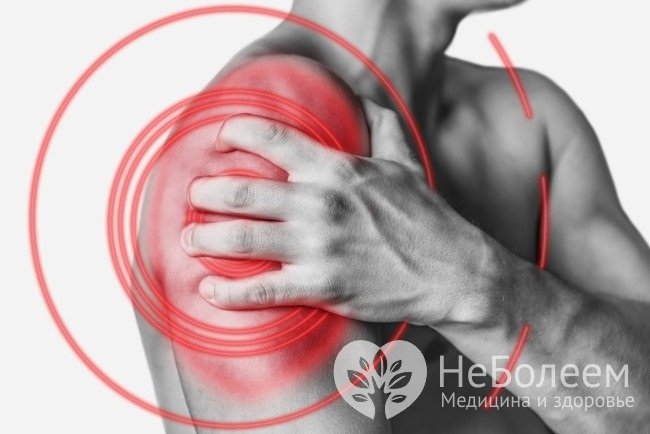 Перегрузка плечевого сустава, микротравмы, разрыв и растяжение связок могут приводить к воспалительному процессу – бурситу