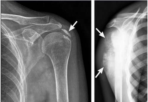 Рентгеноскопия – один из методов диагностики бурсита плечевого устава