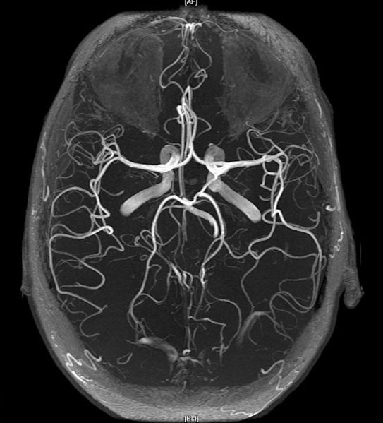 Подтвердить диагноз церебральный атеросклероз позволяет МРТ сосудов головного мозга
