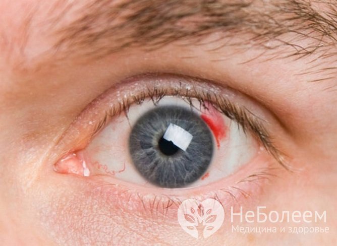 Массивное внутриглазное кровоизлияние при диабетической ретинопатии грозит утратой зрения
