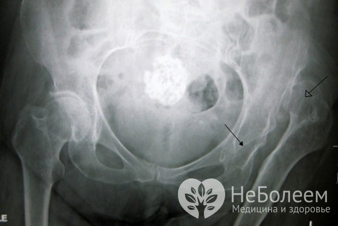Дисплазия тазобедренного сустава по рентгенографии
