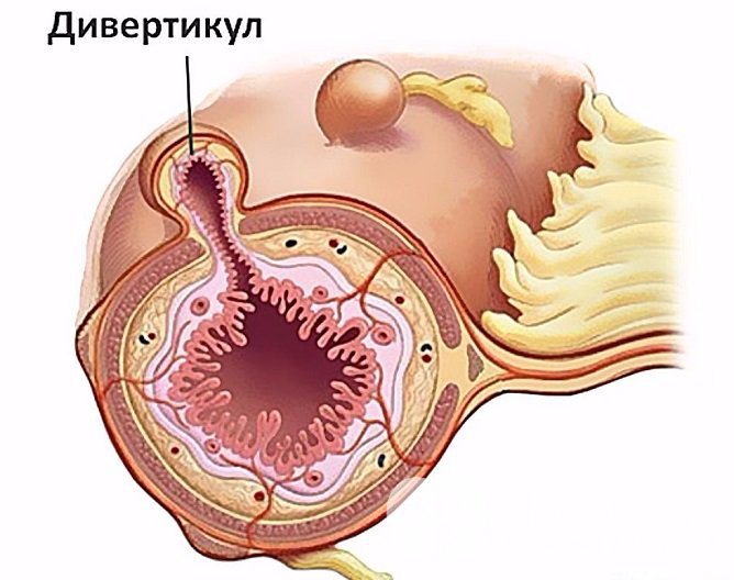 Признаки дивертикулеза кишечника