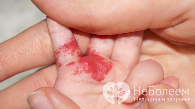 Гемангиома на руке у ребенка часто подвергается травматизации и кровоточит