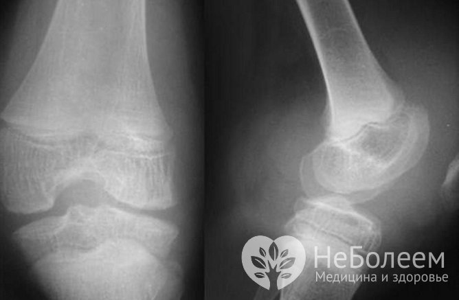 Для диагностики гемартроза коленного сустава выполняют рентгенографию