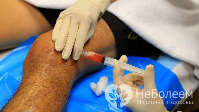 Внутрисуставная пункция при гемартрозе коленного сустава выполняется, когда объем крови в полости сустава превышает 25-35 мл