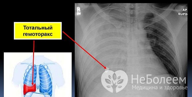 Гемоторакс в результате ранения грудной клетки, рентгенография