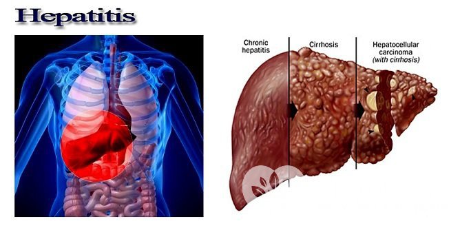Хронический гепатит С приводит к циррозу печени и гепатоцеллюлярной карциноме