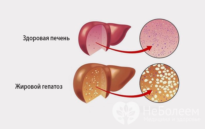 Гепатоз Печени Как Лечить Диета