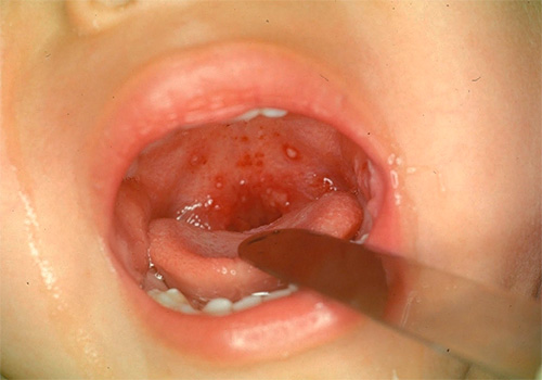 Герпетическая ангина у детей: симптомы, лечение