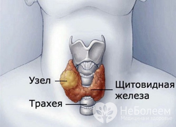 Узловая гиперплазия щитовидной железы