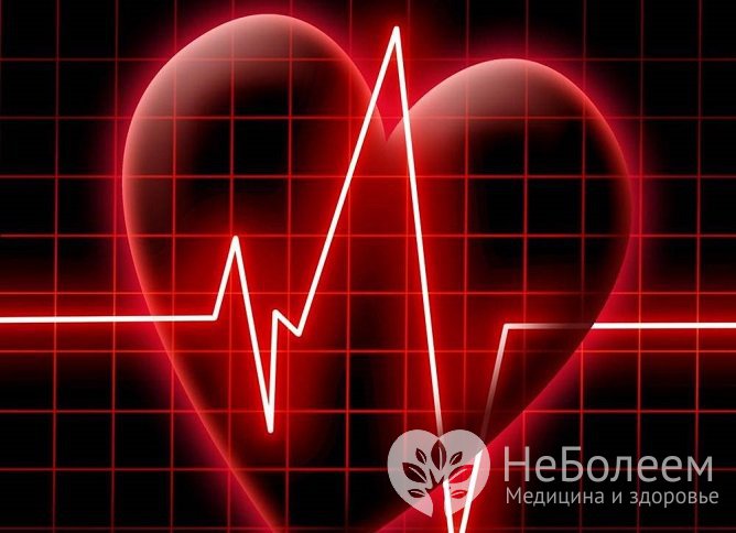 Одно из осложнений гипогликемической комы – инфаркт миокарда