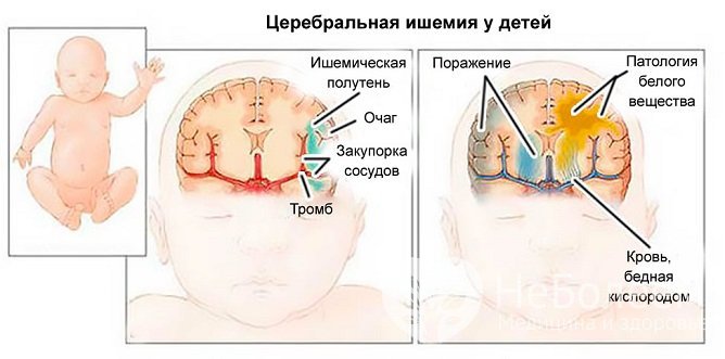 Возможные осложнения и последствия гипоксии у новорожденных