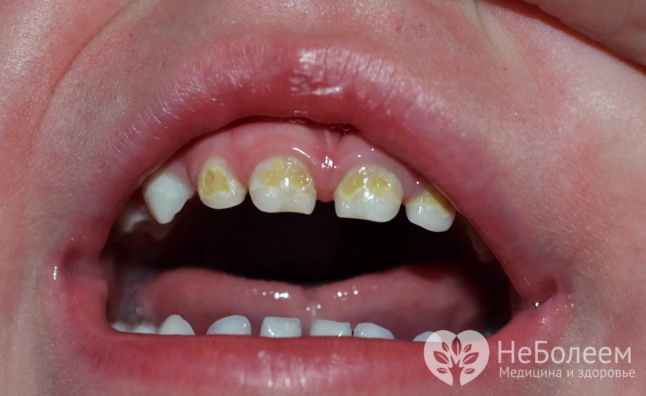 Симптомы гипоплазии зубов