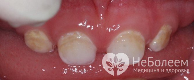 При системной гипоплазии поражаются все зубы или их большинство